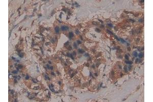 Detection of GPX4 in Human Breast cancer Tissue using Polyclonal Antibody to Glutathione Peroxidase 4 (GPX4)