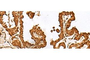 Immunohistochemistry of paraffin-embedded Human thyroid cancer tissue using FAM50A Polyclonal Antibody at dilution of 1:25(x200) (FAM50A 抗体)