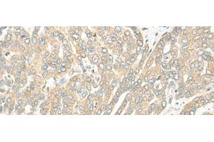 Immunohistochemistry of paraffin-embedded Human liver cancer tissue using ROM1 Polyclonal Antibody at dilution of 1:25(x200) (ROM1 抗体)