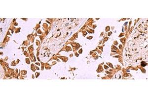 Immunohistochemistry of paraffin-embedded Human lung cancer tissue using IRX1 Polyclonal Antibody at dilution of 1:35(x200) (IRX1 抗体)
