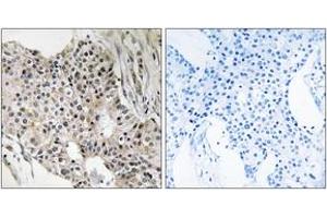 Immunohistochemistry analysis of paraffin-embedded human breast carcinoma tissue, using UEVLD Antibody. (UEVLD 抗体  (AA 141-190))