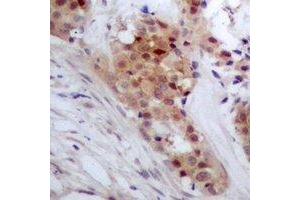 Immunohistochemical analysis of TP53INP2 staining in human breast cancer formalin fixed paraffin embedded tissue section.