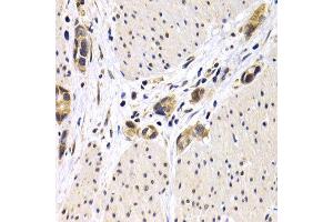 Immunohistochemistry of paraffin-embedded human stomach cancer using ATF2 antibody at dilution of 1:200 (400x lens). (ATF2 抗体)