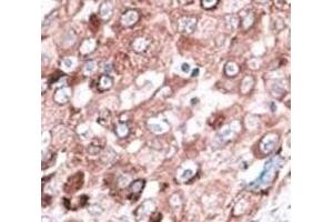 IHC analysis of FFPE hepatocarcinoma cancer tissue stained with the Bak antibody (BAK1 抗体  (AA 56-91))