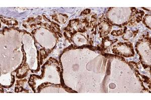 ABIN6267192 at 1/100 staining Human thyroid cancer tissue by IHC-P. (tau 抗体  (pSer202))