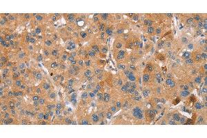 Immunohistochemistry of paraffin-embedded Human liver cancer using PLIN2 Polyclonal Antibody at dilution of 1:30 (ADRP 抗体)
