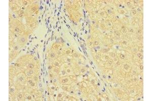 Immunohistochemistry of paraffin-embedded human liver cancer using ABIN7174695 at dilution of 1:100 (C1ORF111 抗体  (AA 1-114))