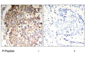 Immunohistochemical analysis of paraffin-embedded human breast carcinoma tissue using PTPN6 (phospho Y536) polyclonal antibody .