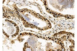 ABIN6263079 and ABIN6272518 at 1/100 staining Human ovarian cancer by IHC-P. (Necdin-Like 2 抗体  (Internal Region))