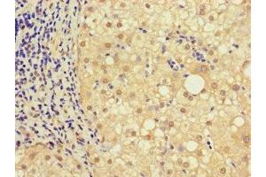 Immunohistochemistry of paraffin-embedded human liver cancer using ABIN7161926 at dilution of 1:100 (NRIP3 抗体  (AA 1-241))
