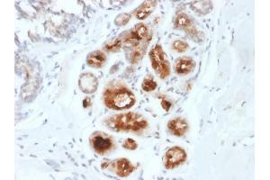 Formalin-fixed, paraffin-embedded human Breast Carcinoma stained with Mammaglobin-Monospecific Mouse Monoclonal Antibody (MGB1/2000). (Mammaglobin A 抗体)