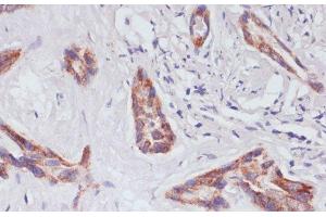 Immunohistochemistry of paraffin-embedded Human liver cancer using RAP1A Polyclonal Antibody at dilution of 1:100 (40x lens). (RAP1A 抗体)