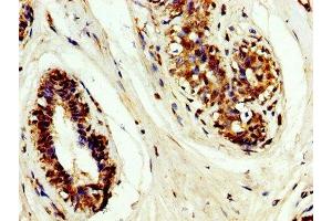 IHC image of ABIN7159489 diluted at 1:200 and staining in paraffin-embedded human breast cancer performed on a Leica BondTM system. (TIMP3 抗体  (AA 1-184))