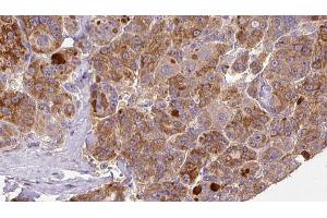ABIN6273925 at 1/100 staining Human liver cancer tissue by IHC-P. (GNRHR2 抗体)