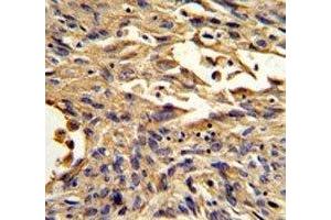 IHC analysis of FFPE human lung carcinoma stained with S100A10 antibody