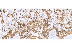 Immunohistochemistry of paraffin-embedded Human gastric cancer tissue using PHF6 Polyclonal Antibody at dilution of 1:85(x200) (PHF6 抗体)