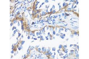Immunohistochemistry of paraffin-embedded Human lung cancer using HLA-DRB3 Polyclonal Antibody at dilution of 1:100 (40x lens). (HLA-DRB3 抗体)