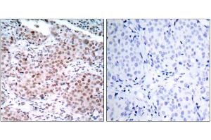 Immunohistochemical analysis of paraffin-embedded human breast carcinoma tissue using Estrogen Receptor-α (phospho-Ser104) antibody (E011070). (Estrogen Receptor alpha 抗体  (pSer104))