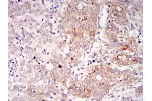 Immunohistochemical analysis of paraffin-embedded human cervical cancer tissues using BLNK monoclonal antibody, clone 5G9  with DAB staining. (B-Cell Linker 抗体)