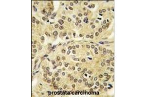 Formalin-fixed and paraffin-embedded human prostata carcinoma tissue reacted with TIEG antibody (N-term) (ABIN392159 and ABIN2841880) , which was peroxidase-conjugated to the secondary antibody, followed by DAB staining. (KLF10/TIEG1 抗体  (N-Term))