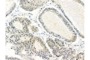 ABIN6259977 and ABIN6276522 at 1/100 staining Human ovarian cancer by IHC-P.