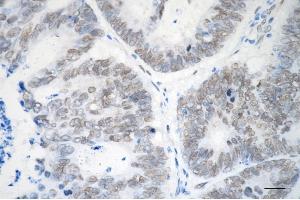 Immunohistochemistry was performed on paraffin-embedded human sigmoid colon carcinoma using EHMT2 antibody (ABIN7797609), 1:200). (Recombinant EHMT2 抗体)