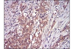 Immunohistochemical analysis of paraffin-embedded human cervical cancer tissues using DDIT3 mouse mAb with DAB staining. (DDIT3 抗体  (AA 87-192))
