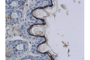 Formalin-fixed and paraffin embedded human lung carcinoma labeled with Anti-CNR2/CB2 Polyclonal Antibody, Unconjugated (ABIN680168) at 1:200 followed by conjugation to the secondary antibody and DAB staining. (CNR2 抗体  (AA 251-350))