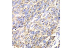 Immunohistochemistry of paraffin-embedded human esophageal cancer using ACY1 antibody at dilution of 1:100 (x40 lens). (Aminoacylase 1 抗体)