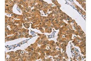 The image on the left is immunohistochemistry of paraffin-embedded Human breast cancer tissue using ABIN7189712(AGAP2 Antibody) at dilution 1/30, on the right is treated with synthetic peptide. (AGAP2 抗体)