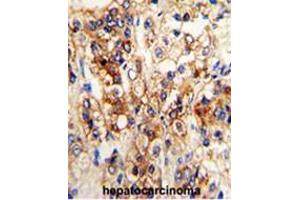Formalin-fixed and paraffin-embedded human hepatocarcinoma reacted with CYP2J2 Antibody (N-term), which was peroxidase-conjugated to the secondary antibody, followed by DAB staining. (CYP2J2 抗体  (N-Term))