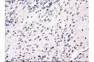 Immunohistochemical staining of paraffin-embedded Adenocarcinoma of breast tissue using anti-MRI1 mouse monoclonal antibody. (MRI1 抗体)