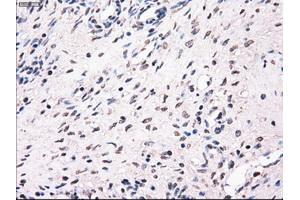 Immunohistochemical staining of paraffin-embedded Adenocarcinoma of breast tissue using anti-MRI1 mouse monoclonal antibody. (MRI1 抗体)