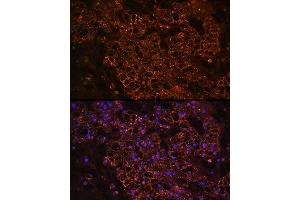 Immunofluorescence analysis of human kidney cancer using PCK1 Rabbit pAb (ABIN3022753, ABIN3022754, ABIN3022755 and ABIN6219210) at dilution of 1:100 (40x lens).