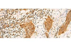 Immunohistochemistry of paraffin-embedded Human esophagus cancer tissue using GINS2 Polyclonal Antibody at dilution of 1:50(x200) (GINS2 抗体)