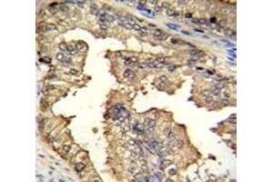 IHC testing of PRMT4 antibody and FFPE human prostate carcinoma. (CARM1 抗体  (AA 346-377))