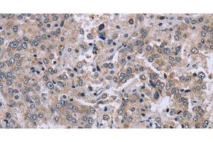 Immunohistochemistry of paraffin-embedded Human liver cancer tissue using EID1 Polyclonal Antibody at dilution 1:40 (EID1 抗体)
