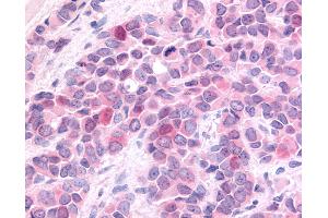 Anti-HUNK / B19 antibody IHC of human Breast, Carcinoma. (HUNK 抗体  (Internal Region))