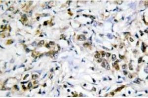 Immunohistochemistry (IHC) analyzes of Galectin-4 antibody in paraffin-embedded human liver carcinoma tissue. (GAL4 抗体)