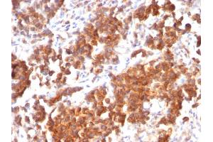 Formalin-fixed, paraffin-embedded human Parathyroid Mass stained with VEGI Mouse Recombinant Monoclonal Antibody (rVEGI /1283).