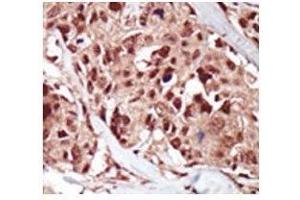 IHC analysis of FFPE human breast carcinoma tissue stained with the BRD4 antibody (BRD4 抗体  (AA 1-30))