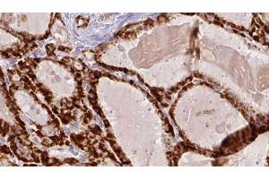 ABIN6267193 at 1/100 staining Human thyroid cancer tissue by IHC-P. (tau 抗体  (pSer416))