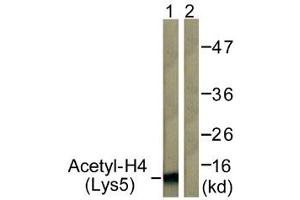 Immunohistochemistry analysis of paraffin-embedded human breast carcinoma tissue, using Histone H4 (Acetyl-Lys5) Antibody. (Histone H4 抗体  (acLys5))