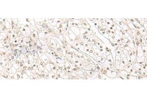 Immunohistochemistry of paraffin-embedded Human kidney cancer tissue using HENMT1 Polyclonal Antibody at dilution of 1:30(x200) (HENMT1 抗体)