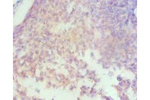 Immunohistochemistry of paraffin-embedded human cervical cancer using ABIN7155960 at dilution of 1:100 (HAS3 抗体  (AA 339-553))