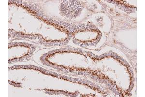 IHC-P Image Immunohistochemical analysis of paraffin-embedded human endometrial cancer, using GALNT7, antibody at 1:100 dilution. (GALNT7 抗体  (Center))