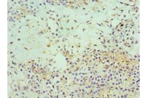 Immunohistochemistry of paraffin-embedded human breast cancer using ABIN7152153 at dilution of 1:100 (EIF3E 抗体  (AA 1-445))