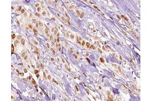 ABIN6266541 at 1/100 staining human breast carcinoma tissue sections by IHC-P. (FLI1 抗体  (Internal Region))
