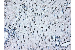 Immunohistochemical staining of paraffin-embedded Adenocarcinoma of colon tissue using anti-BRAFmouse monoclonal antibody. (BRAF 抗体)