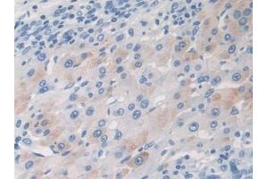 Detection of TARC in Mouse Liver cancer Tissue using Polyclonal Antibody to Thymus Activation Regulated Chemokine (TARC) (CCL17 抗体  (AA 12-83))